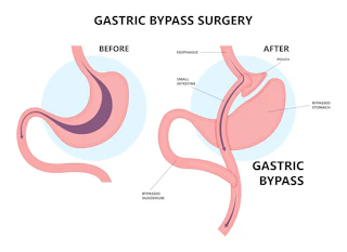 Gastric Bypass - Bariatric Surgery for Teens
