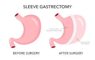 Gastric Sleeve (Sleeve Gastrectomy) - Bariatric Surgery for Teens